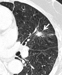 lobe pulmonary nodule