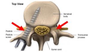 pedicle screw